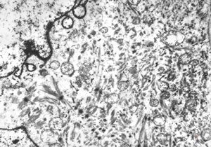 M,29y. | testis - embryonal rhabdomyosarcoma in teratoma